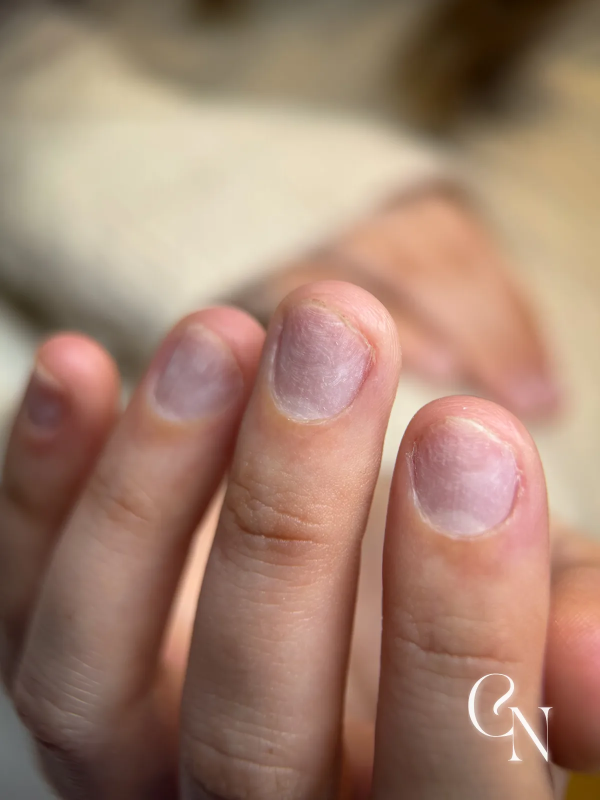 Pack ongles rongés